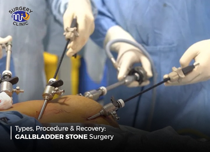 Types, Procedure & Recovery: Gallbladder Stone Surgery